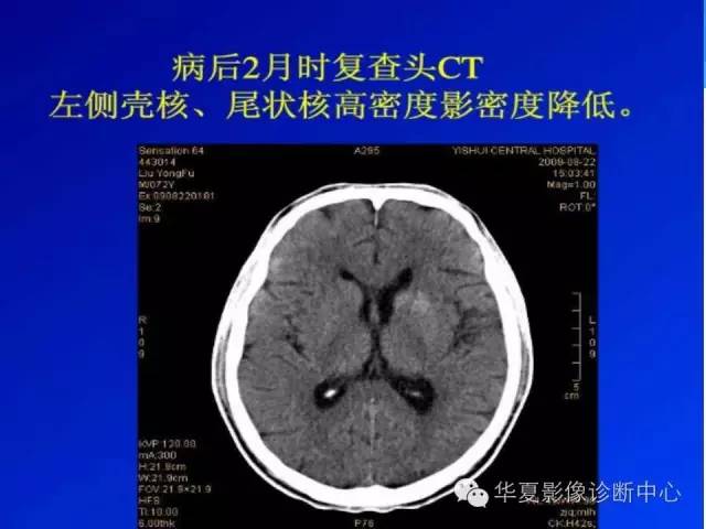 【病例】糖尿病非酮症性高渗状态所致偏侧舞蹈症1例MR影像表现 【病例】糖尿病非酮症性高渗状态所致偏侧舞蹈症1例MR影像表现