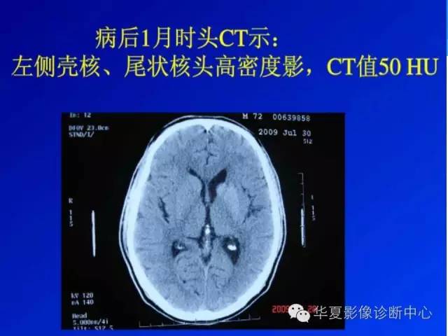【病例】糖尿病非酮症性高渗状态所致偏侧舞蹈症1例MR影像表现 【病例】糖尿病非酮症性高渗状态所致偏侧舞蹈症1例MR影像表现