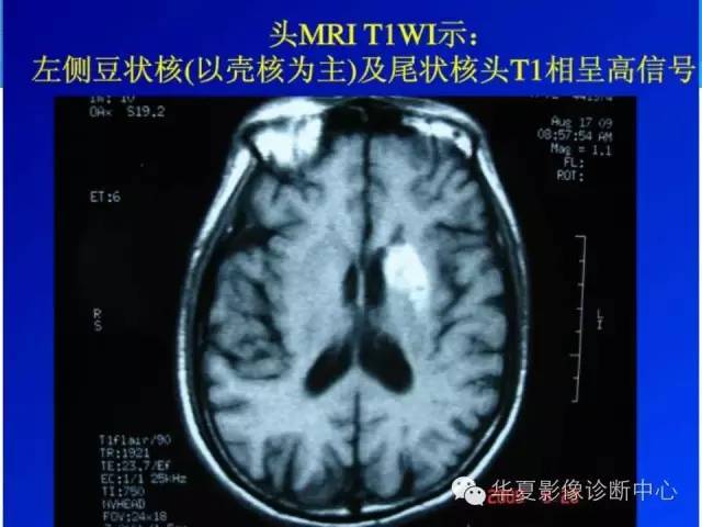 【病例】糖尿病非酮症性高渗状态所致偏侧舞蹈症1例MR影像表现 【病例】糖尿病非酮症性高渗状态所致偏侧舞蹈症1例MR影像表现