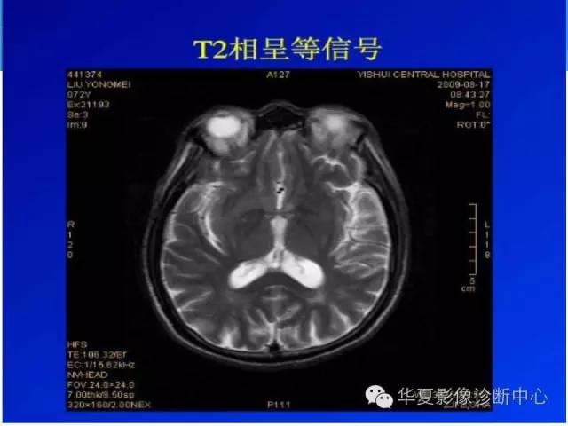 【病例】糖尿病非酮症性高渗状态所致偏侧舞蹈症1例MR影像表现 【病例】糖尿病非酮症性高渗状态所致偏侧舞蹈症1例MR影像表现