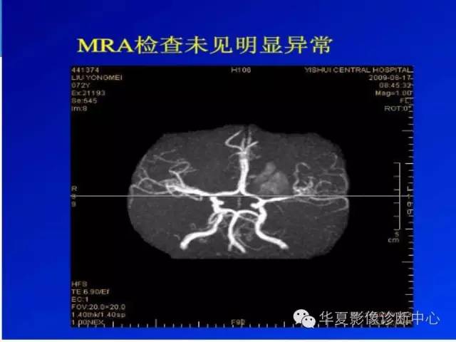 【病例】糖尿病非酮症性高渗状态所致偏侧舞蹈症1例MR影像表现 【病例】糖尿病非酮症性高渗状态所致偏侧舞蹈症1例MR影像表现
