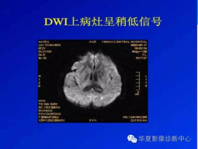 【病例】糖尿病非酮症性高渗状态所致偏侧舞蹈症1例MR影像表现 【病例】糖尿病非酮症性高渗状态所致偏侧舞蹈症1例MR影像表现