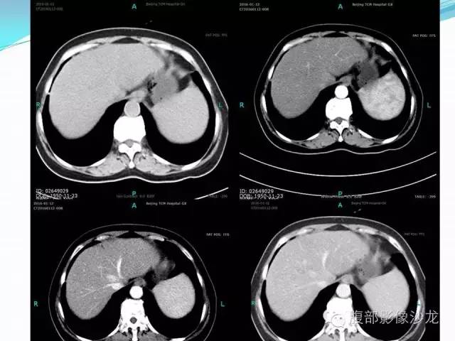 【病例】胃窦中分化腺癌1例CT影像表现 【病例】胃窦中分化腺癌1例CT影像表现