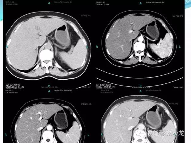 【病例】胃窦中分化腺癌1例CT影像表现 【病例】胃窦中分化腺癌1例CT影像表现
