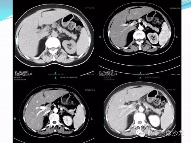 【病例】胃窦中分化腺癌1例CT影像表现 【病例】胃窦中分化腺癌1例CT影像表现