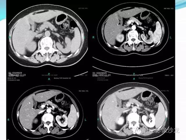 【病例】胃窦中分化腺癌1例CT影像表现 【病例】胃窦中分化腺癌1例CT影像表现