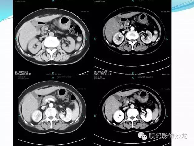 【病例】胃窦中分化腺癌1例CT影像表现 【病例】胃窦中分化腺癌1例CT影像表现