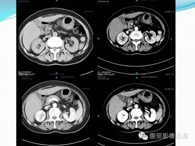 【病例】胃窦中分化腺癌1例CT影像表现 【病例】胃窦中分化腺癌1例CT影像表现