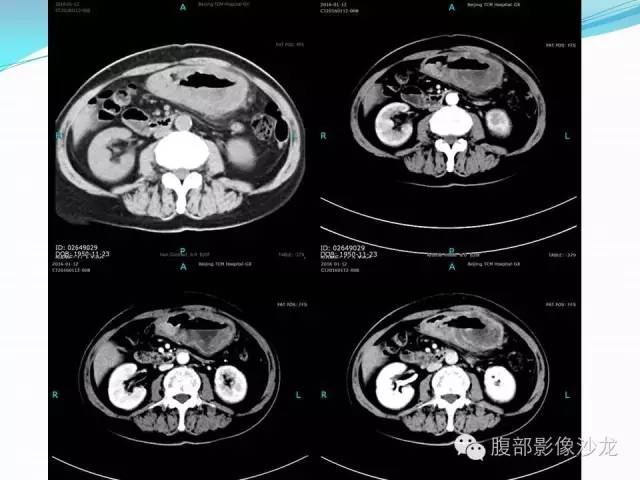 【病例】胃窦中分化腺癌1例CT影像表现 【病例】胃窦中分化腺癌1例CT影像表现