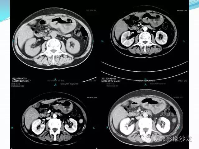【病例】胃窦中分化腺癌1例CT影像表现 【病例】胃窦中分化腺癌1例CT影像表现