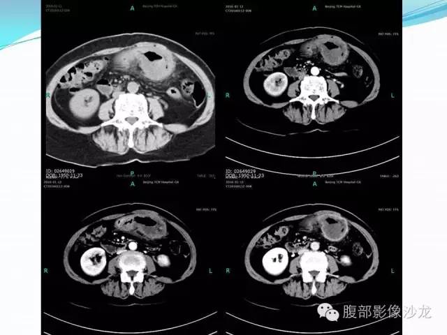 【病例】胃窦中分化腺癌1例CT影像表现 【病例】胃窦中分化腺癌1例CT影像表现