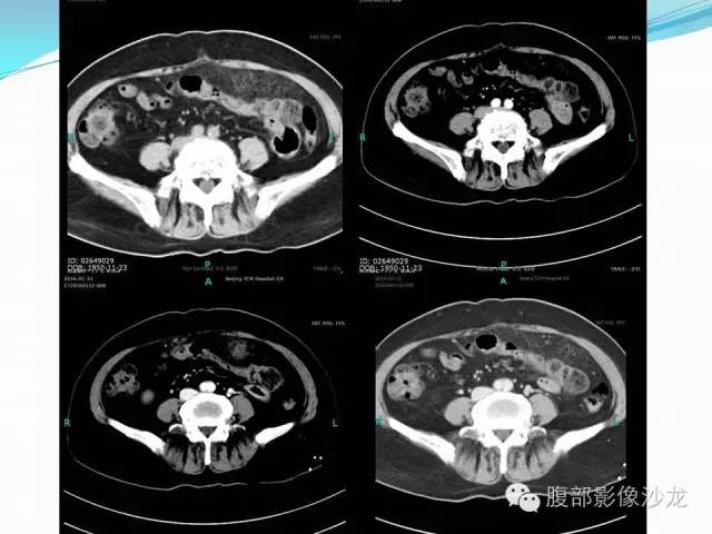 【病例】胃窦中分化腺癌1例CT影像表现 【病例】胃窦中分化腺癌1例CT影像表现