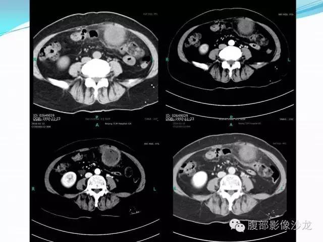 【病例】胃窦中分化腺癌1例CT影像表现 【病例】胃窦中分化腺癌1例CT影像表现