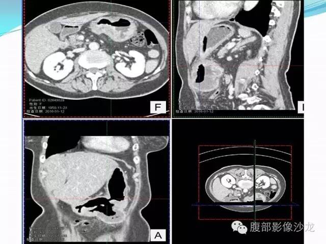 【病例】胃窦中分化腺癌1例CT影像表现 【病例】胃窦中分化腺癌1例CT影像表现