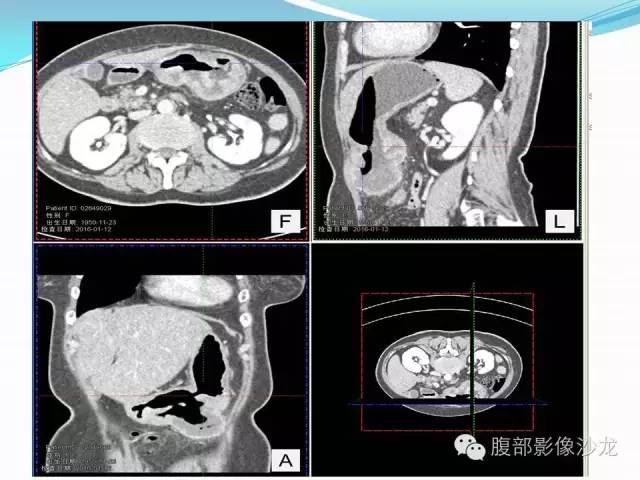 【病例】胃窦中分化腺癌1例CT影像表现 【病例】胃窦中分化腺癌1例CT影像表现