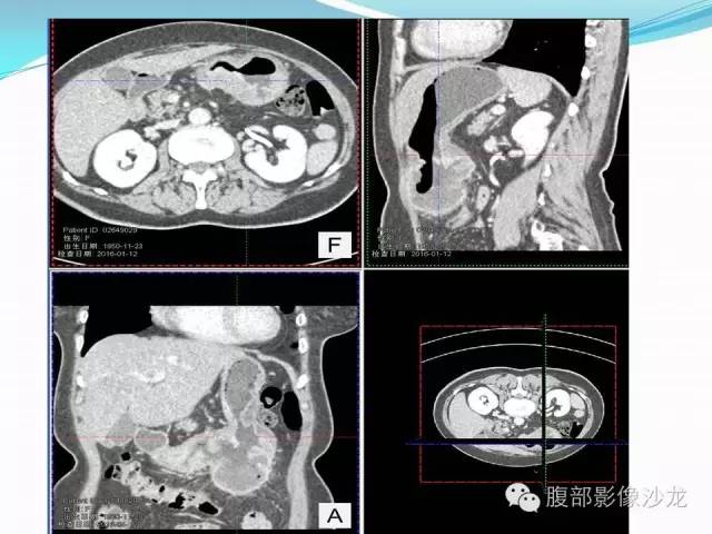 【病例】胃窦中分化腺癌1例CT影像表现 【病例】胃窦中分化腺癌1例CT影像表现