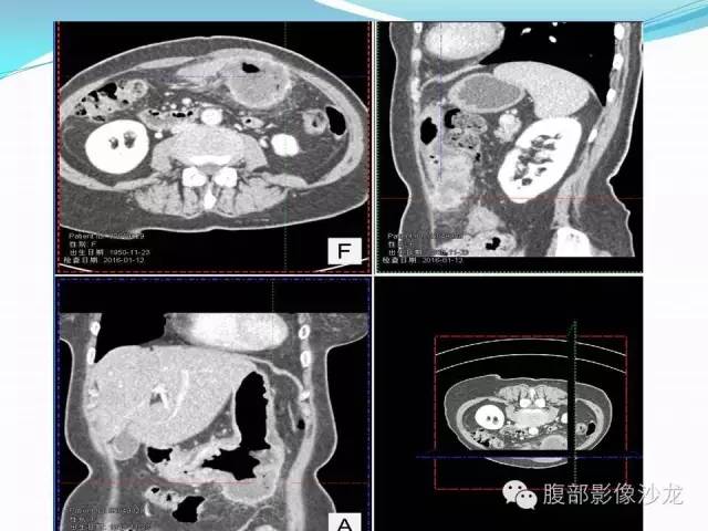 【病例】胃窦中分化腺癌1例CT影像表现 【病例】胃窦中分化腺癌1例CT影像表现
