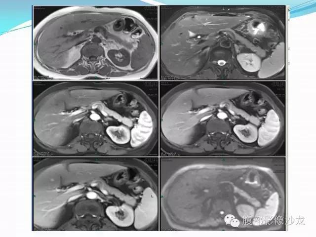 【病例】胃窦中分化腺癌1例CT影像表现 【病例】胃窦中分化腺癌1例CT影像表现