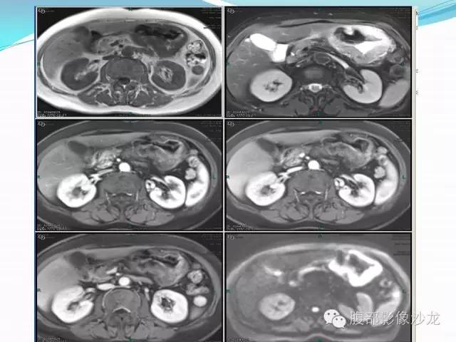 【病例】胃窦中分化腺癌1例CT影像表现 【病例】胃窦中分化腺癌1例CT影像表现