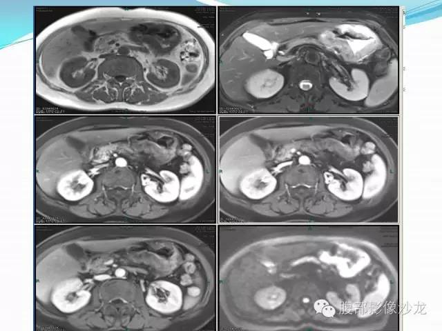 【病例】胃窦中分化腺癌1例CT影像表现 【病例】胃窦中分化腺癌1例CT影像表现
