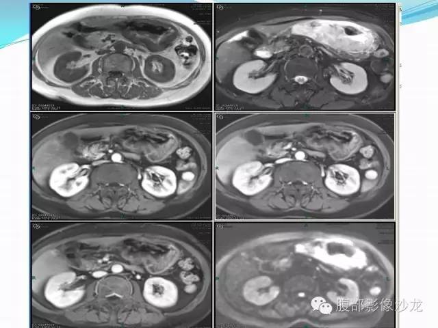 【病例】胃窦中分化腺癌1例CT影像表现 【病例】胃窦中分化腺癌1例CT影像表现