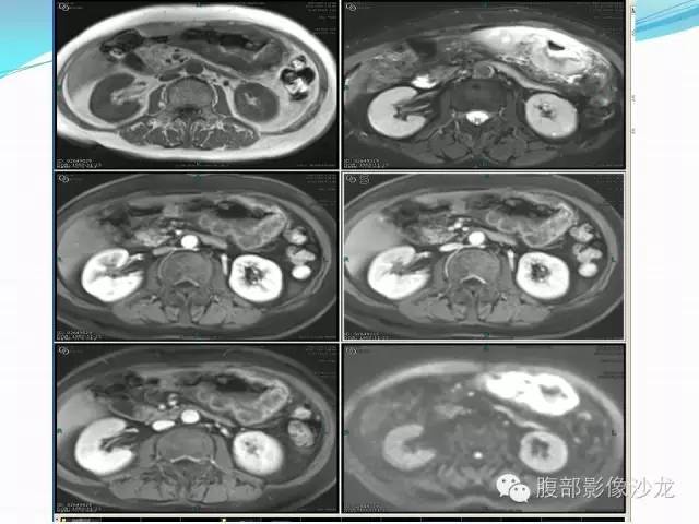 【病例】胃窦中分化腺癌1例CT影像表现 【病例】胃窦中分化腺癌1例CT影像表现