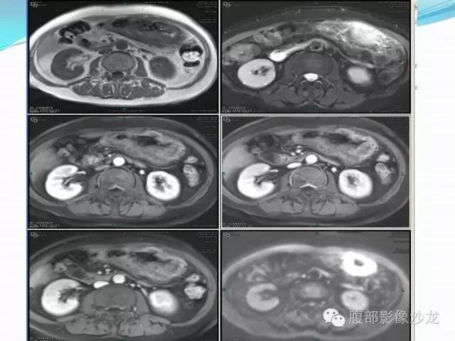 【病例】胃窦中分化腺癌1例CT影像表现 【病例】胃窦中分化腺癌1例CT影像表现