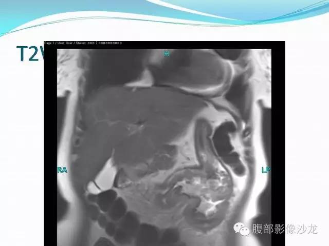 【病例】胃窦中分化腺癌1例CT影像表现 【病例】胃窦中分化腺癌1例CT影像表现