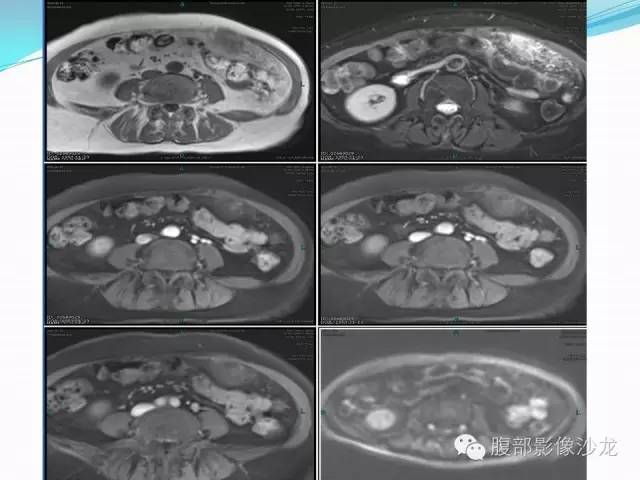 【病例】胃窦中分化腺癌1例CT影像表现 【病例】胃窦中分化腺癌1例CT影像表现