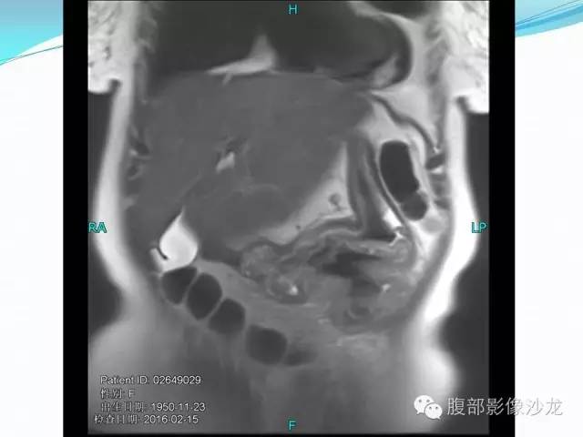 【病例】胃窦中分化腺癌1例CT影像表现 【病例】胃窦中分化腺癌1例CT影像表现