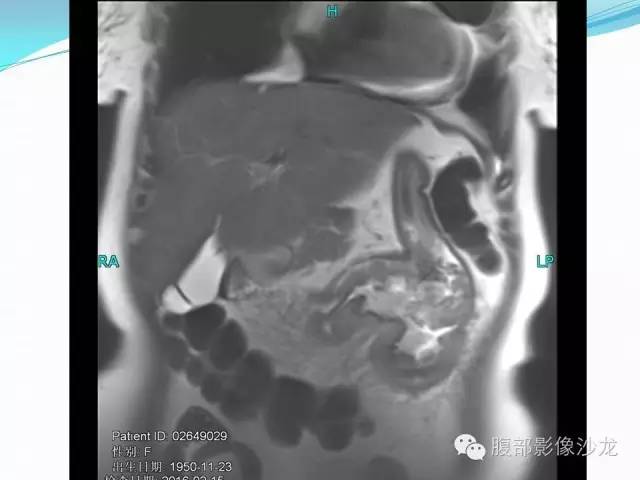 【病例】胃窦中分化腺癌1例CT影像表现 【病例】胃窦中分化腺癌1例CT影像表现