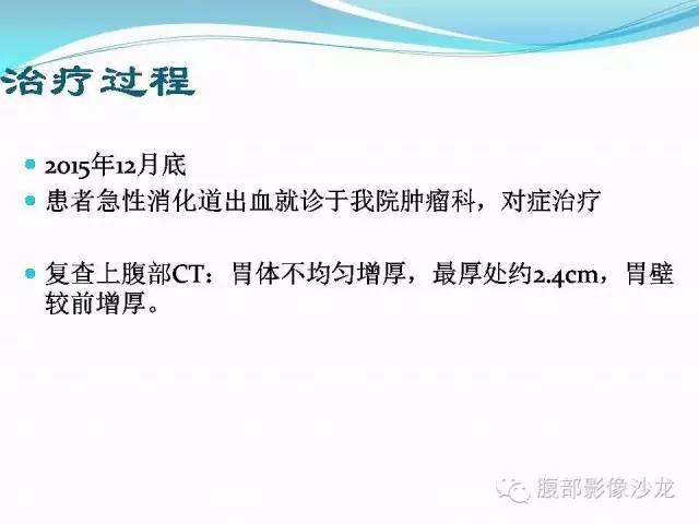 【病例】胃窦中分化腺癌1例CT影像表现 【病例】胃窦中分化腺癌1例CT影像表现
