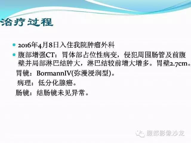 【病例】胃窦中分化腺癌1例CT影像表现 【病例】胃窦中分化腺癌1例CT影像表现