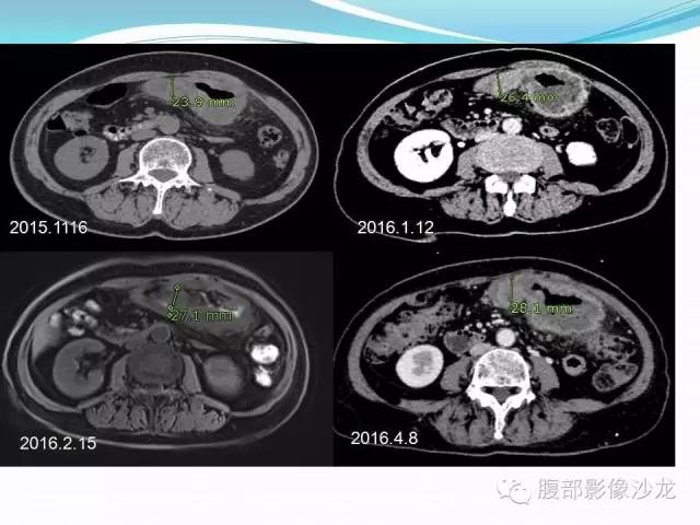 【病例】胃窦中分化腺癌1例CT影像表现 【病例】胃窦中分化腺癌1例CT影像表现