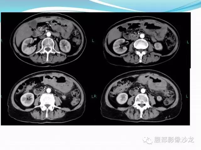 【病例】胃窦中分化腺癌1例CT影像表现 【病例】胃窦中分化腺癌1例CT影像表现
