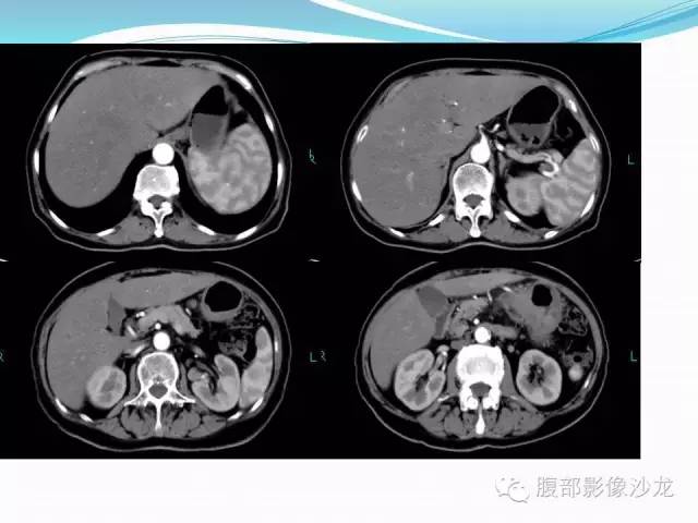 【病例】胃窦中分化腺癌1例CT影像表现 【病例】胃窦中分化腺癌1例CT影像表现