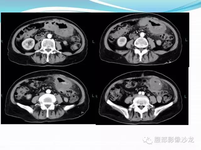 【病例】胃窦中分化腺癌1例CT影像表现 【病例】胃窦中分化腺癌1例CT影像表现