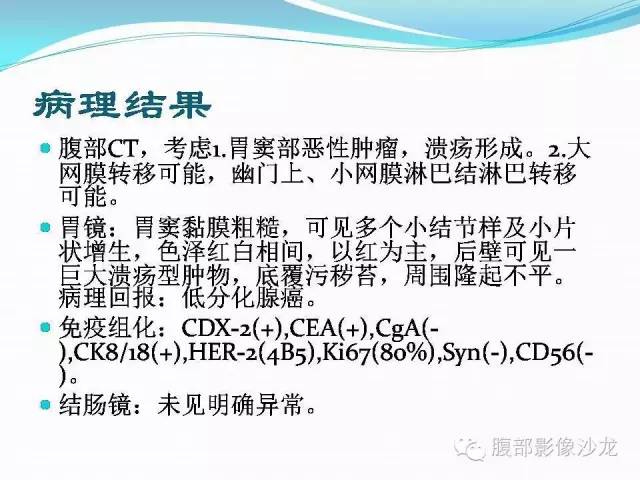 【病例】胃窦中分化腺癌1例CT影像表现 【病例】胃窦中分化腺癌1例CT影像表现