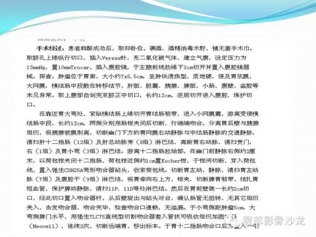 【病例】胃窦中分化腺癌1例CT影像表现 【病例】胃窦中分化腺癌1例CT影像表现