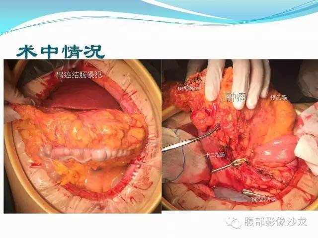 【病例】胃窦中分化腺癌1例CT影像表现 【病例】胃窦中分化腺癌1例CT影像表现