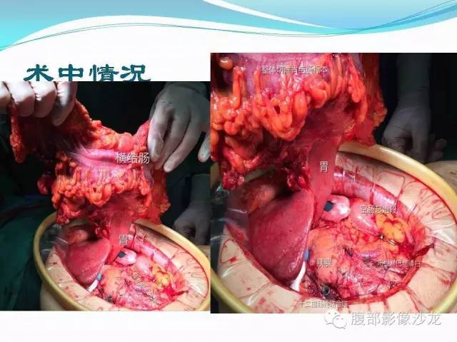 【病例】胃窦中分化腺癌1例CT影像表现 【病例】胃窦中分化腺癌1例CT影像表现