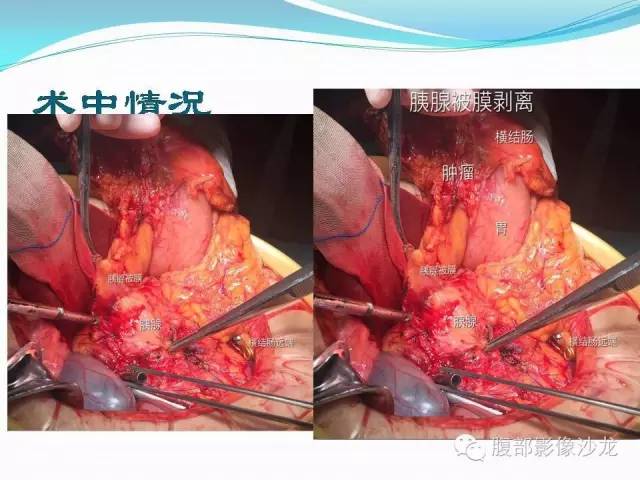 【病例】胃窦中分化腺癌1例CT影像表现 【病例】胃窦中分化腺癌1例CT影像表现