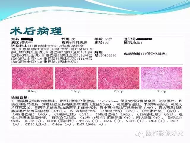 【病例】胃窦中分化腺癌1例CT影像表现 【病例】胃窦中分化腺癌1例CT影像表现