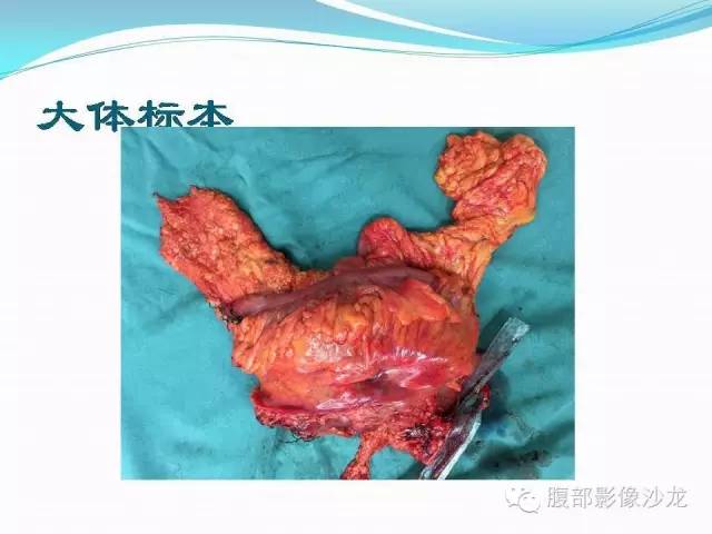 【病例】胃窦中分化腺癌1例CT影像表现 【病例】胃窦中分化腺癌1例CT影像表现