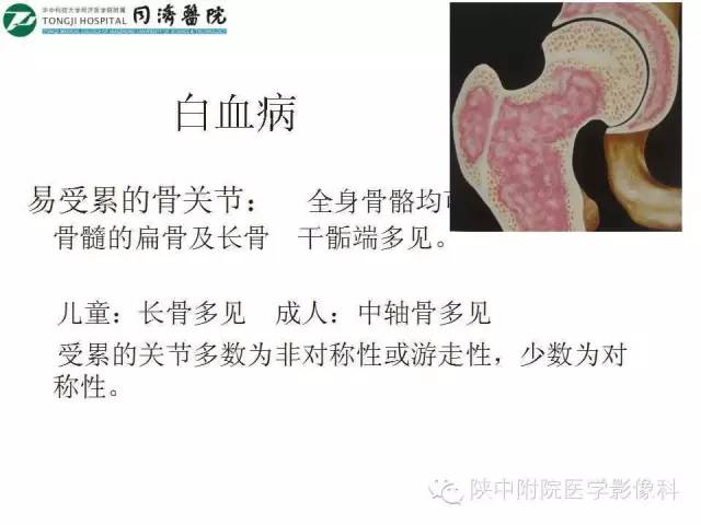 【PPT】血液系统疾病在骨关节的改变——影像学表现