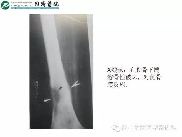 【PPT】血液系统疾病在骨关节的改变——影像学表现