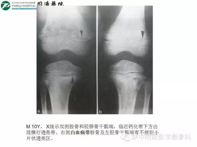 【PPT】血液系统疾病在骨关节的改变——影像学表现