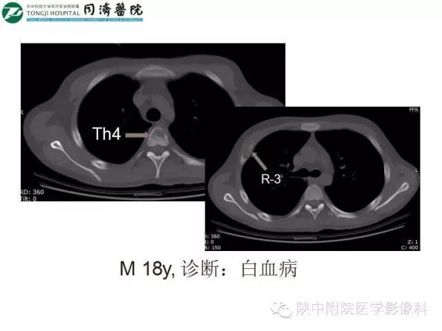 【PPT】血液系统疾病在骨关节的改变——影像学表现