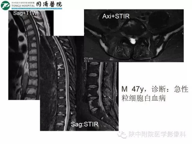 【PPT】血液系统疾病在骨关节的改变——影像学表现
