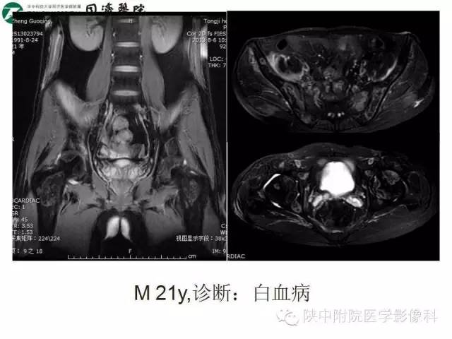 【PPT】血液系统疾病在骨关节的改变——影像学表现
